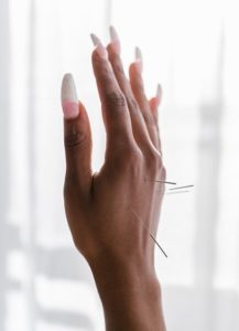 A woman's hand with acupuncture needles placed