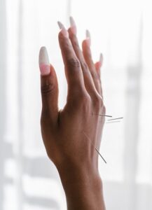 A person's hand with manicured nails, demonstrating several acupuncture needles placed in points on the back of the hand